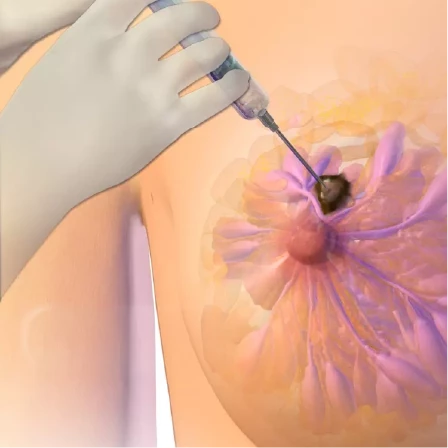 Do Biopsies Make Cancer Spread?