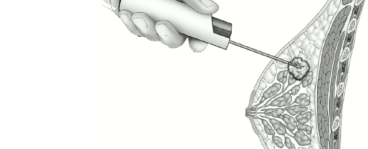 Diagnosis and treatment