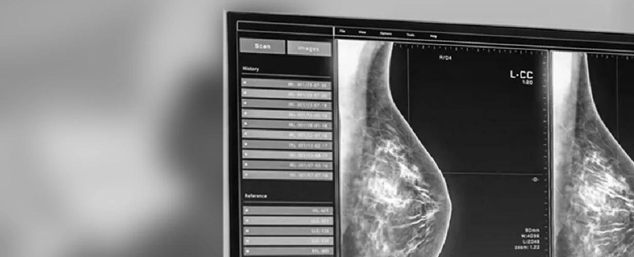 Breast Cancer Screening